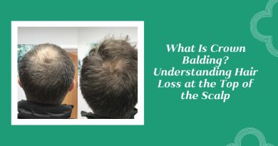 Crown Balding