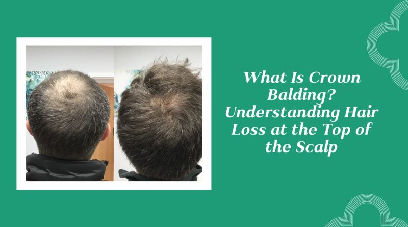Crown Balding
