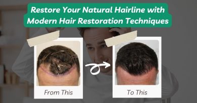 Best hair transplant in jaipur