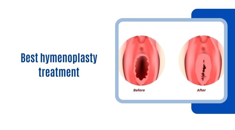 Best hymenoplasty treatment