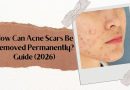 How Can Acne Scars Be Removed Permanently? Guide (2026)
