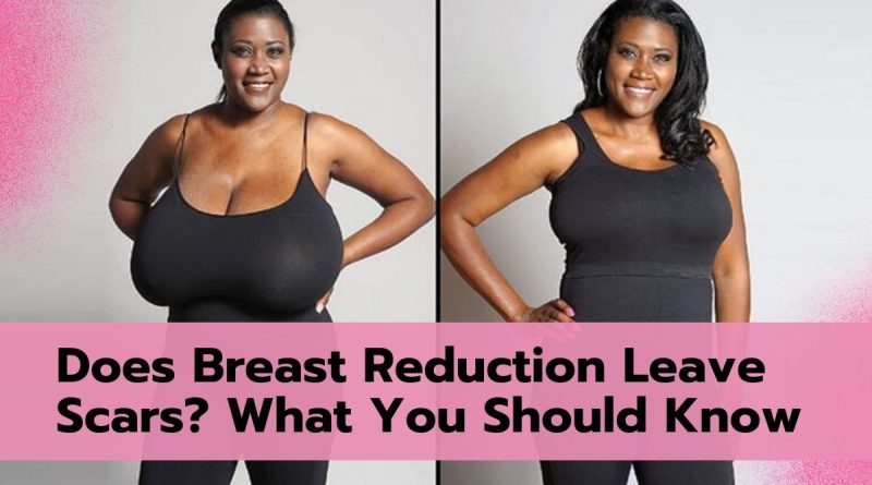 Does Breast Reduction Leave Scars? What You Should Know