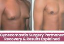Is Gynecomastia Surgery Permanent? Recovery & Results Explained