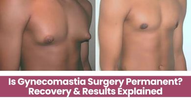 Is Gynecomastia Surgery Permanent? Recovery & Results Explained