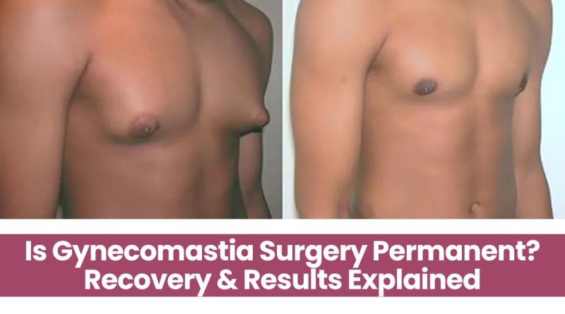 Is Gynecomastia Surgery Permanent? Recovery & Results Explained