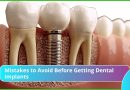 Mistakes to Avoid Before Getting Dental Implants