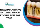 dental implants