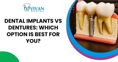 dental implants