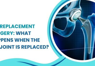Hip Replacement Surgery showing artificial hip joint and replacement procedure