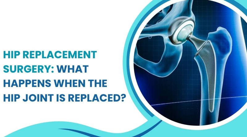 Hip Replacement Surgery showing artificial hip joint and replacement procedure