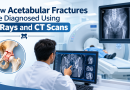 How Acetabular Fractures Are Diagnosed Using X-Rays and CT Scans