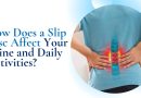 How Does a Slip Disc Affect Your Spine and Daily Activities?