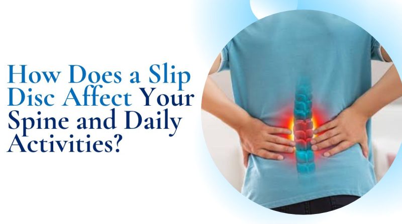 How Does a Slip Disc Affect Your Spine and Daily Activities?